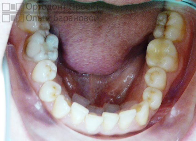 нижние зубы до ортодонтического лечения