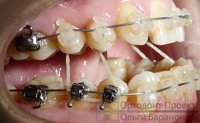 на этапе ортодонтического лечения