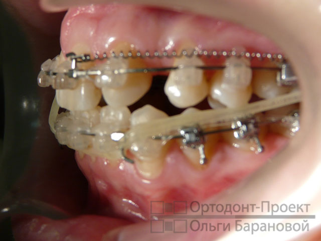 закрытие щели между зубами