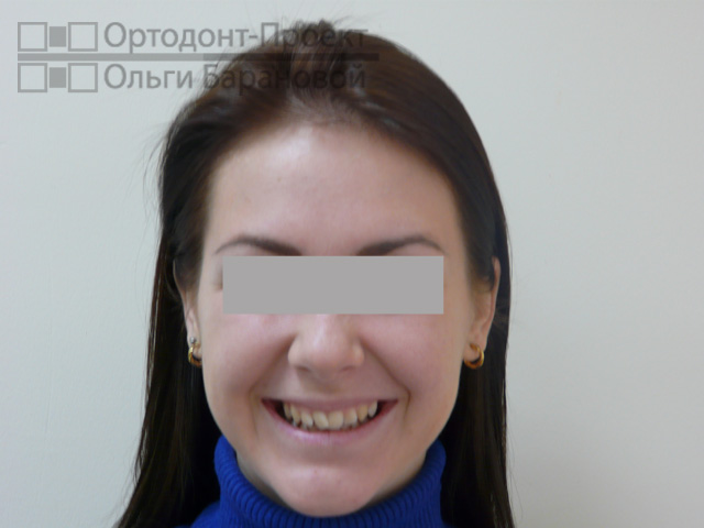 улыбка до ортодонтического лечения