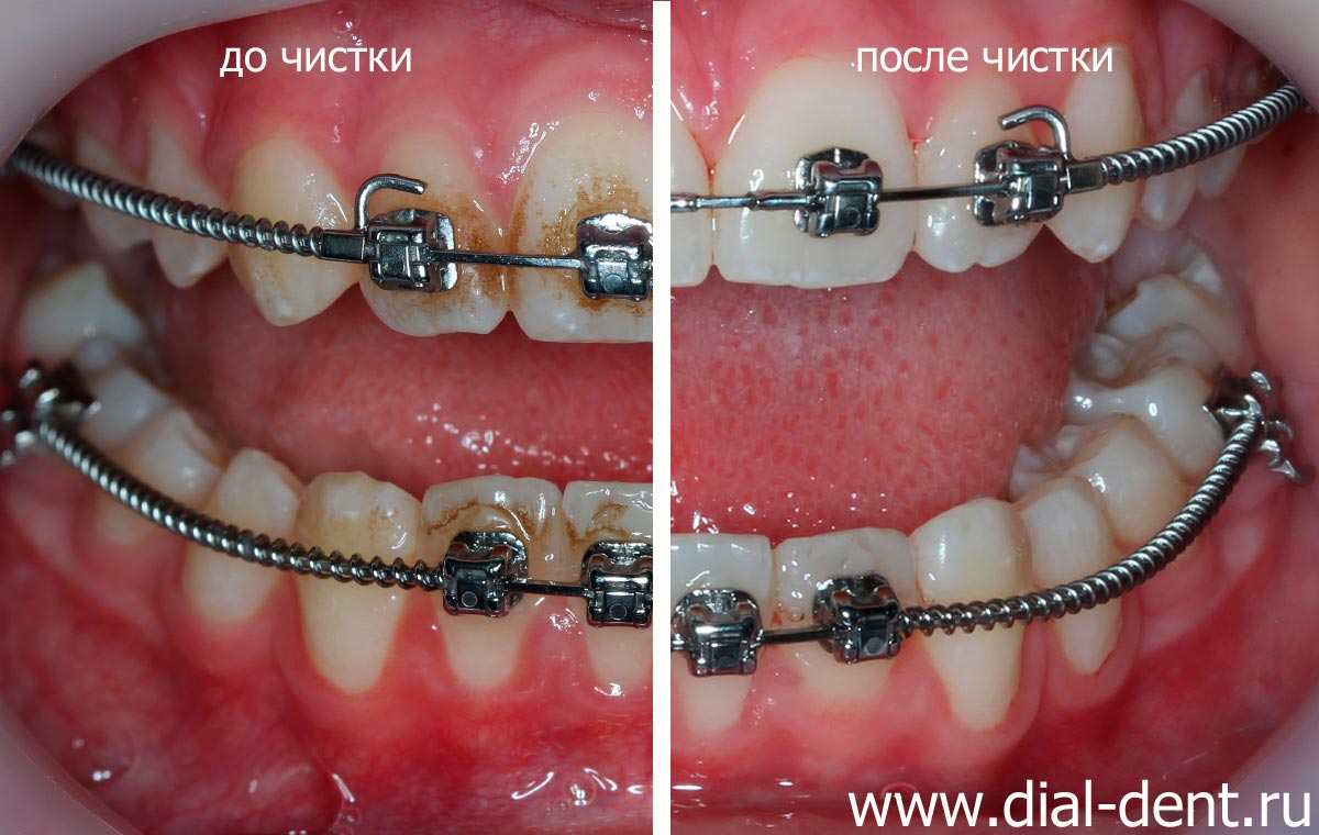 чистка зубов с брекетами методом Air Flow в Диал-Дент