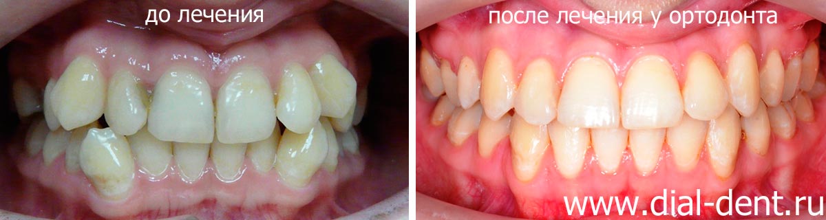 сравнительный результат ортодонтического лечения