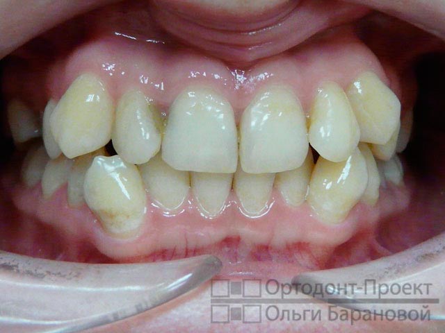 до ортодонтического лечения зубы растут криво