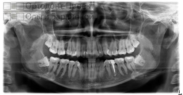 Скученность зубов лечение без брекетов