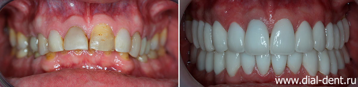 Протезирование зубов с исправлением неправильного прикуса