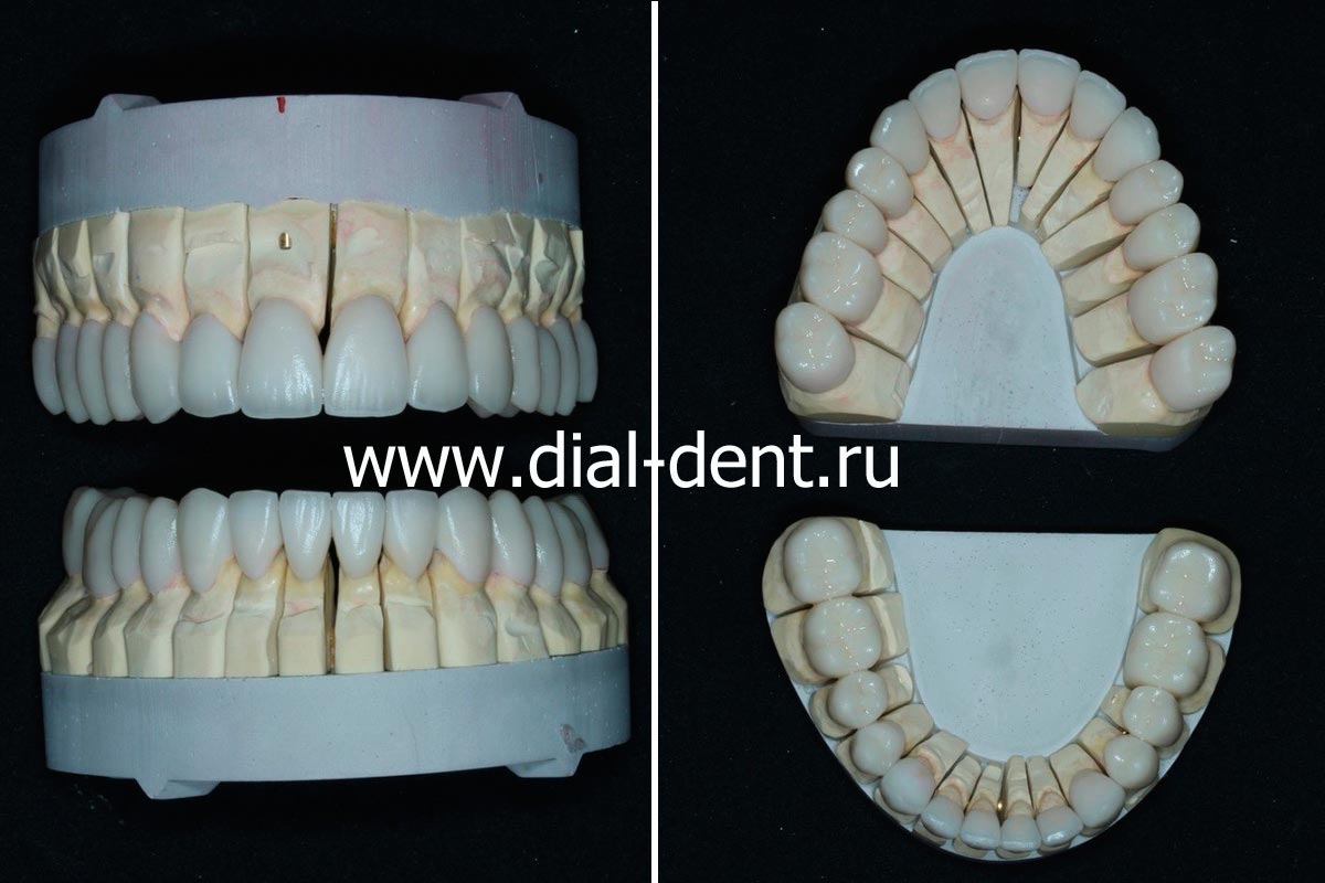 керамические реставрации выполнены в лаборатории Диал-Дент, зубной техник Волк Д.В.