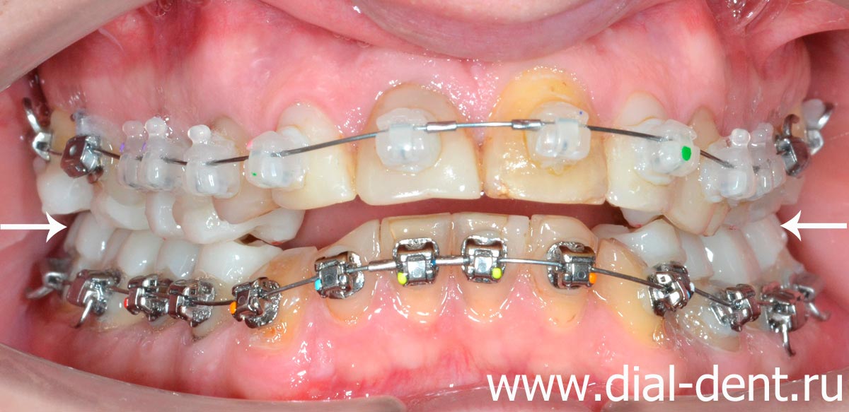 брекет-система Damon на зубах, установлен несъемный ортотик