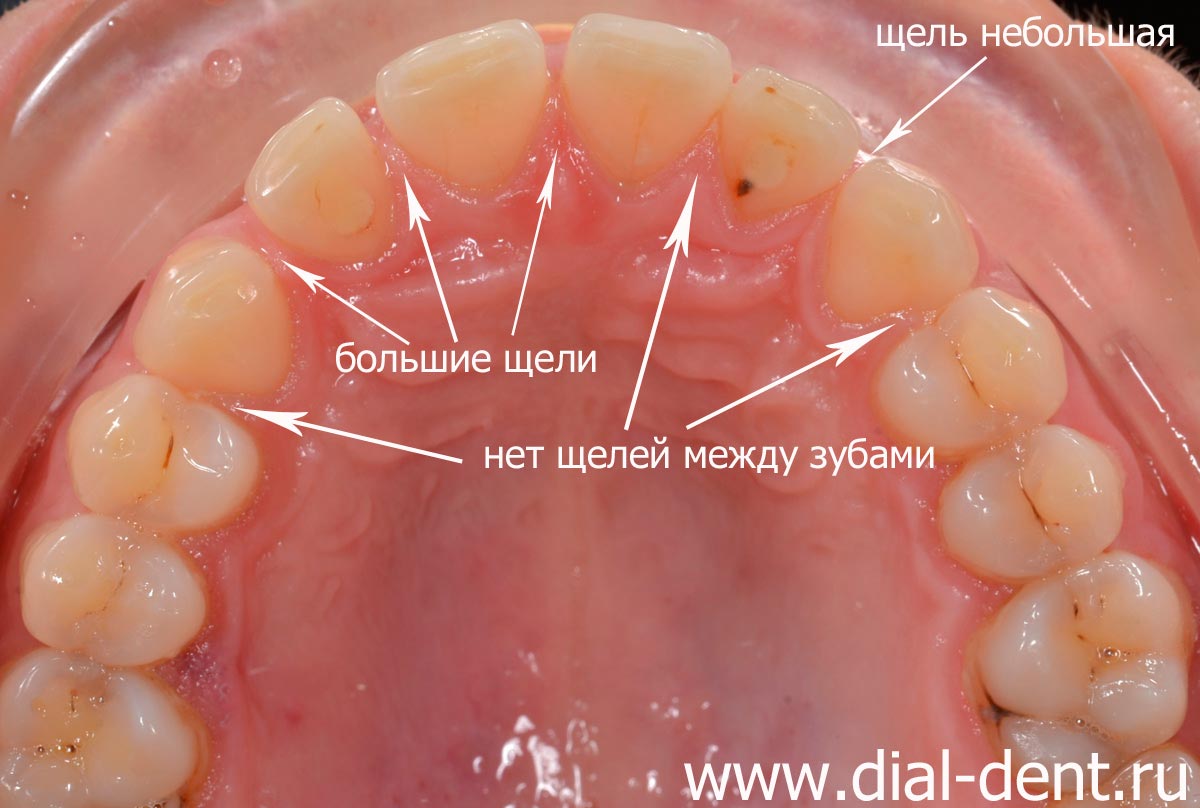 неравномерные щели между зубами