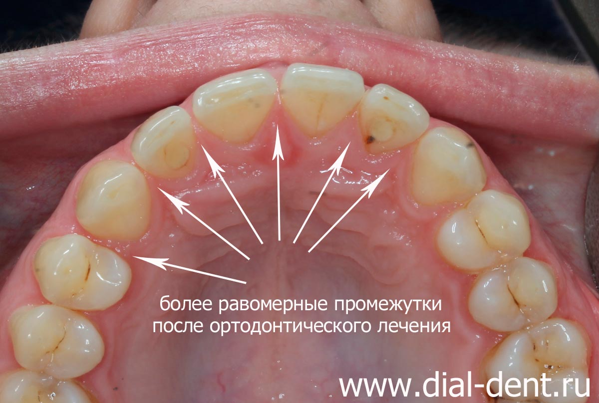 выровнены промежутки между зубами после лечения частичной брекет-системой