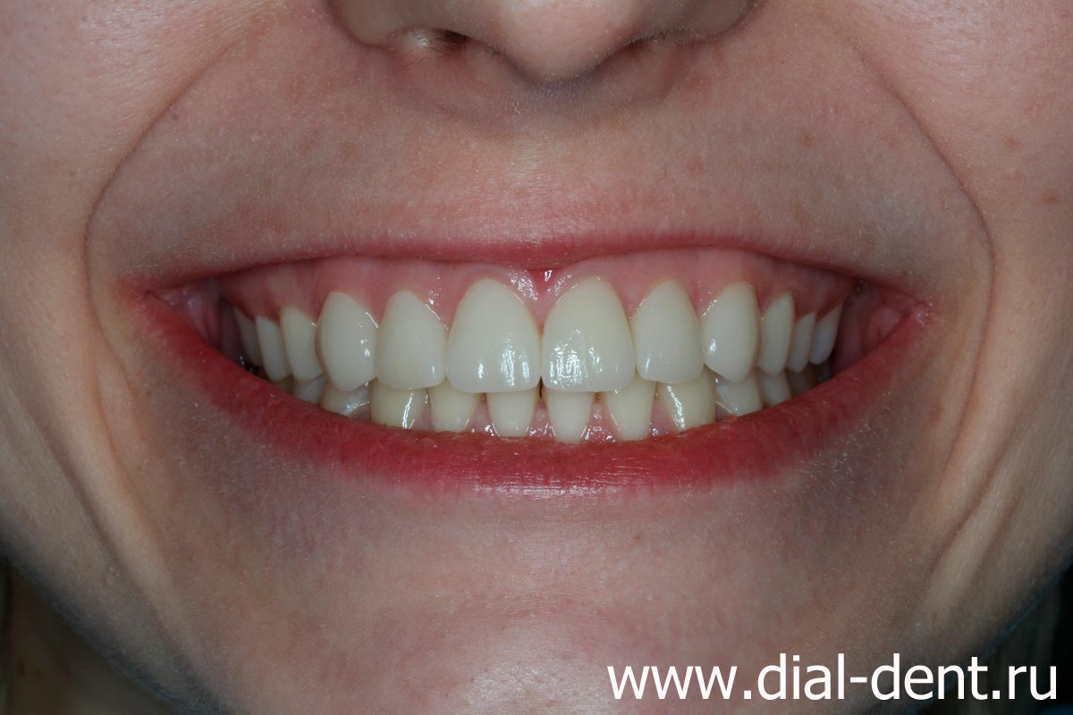 улыбка после комплексной реставрации зубов