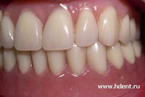 протезирование зубов имплантация