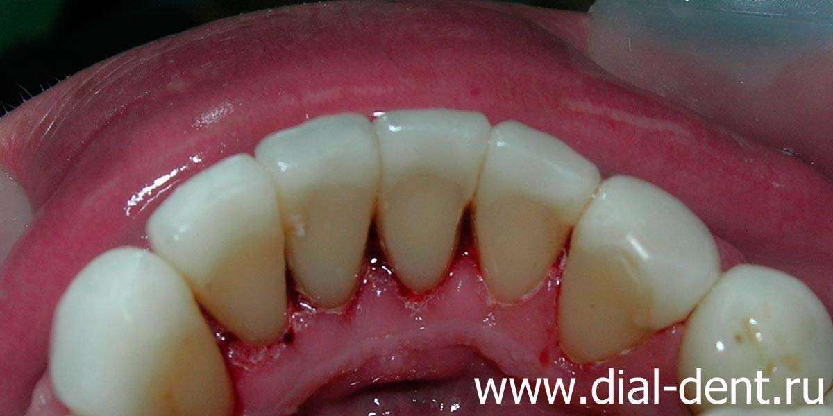 после чистки Air Flow внутренняя поверхность зубов без налета, удален поддесневой зубной камень