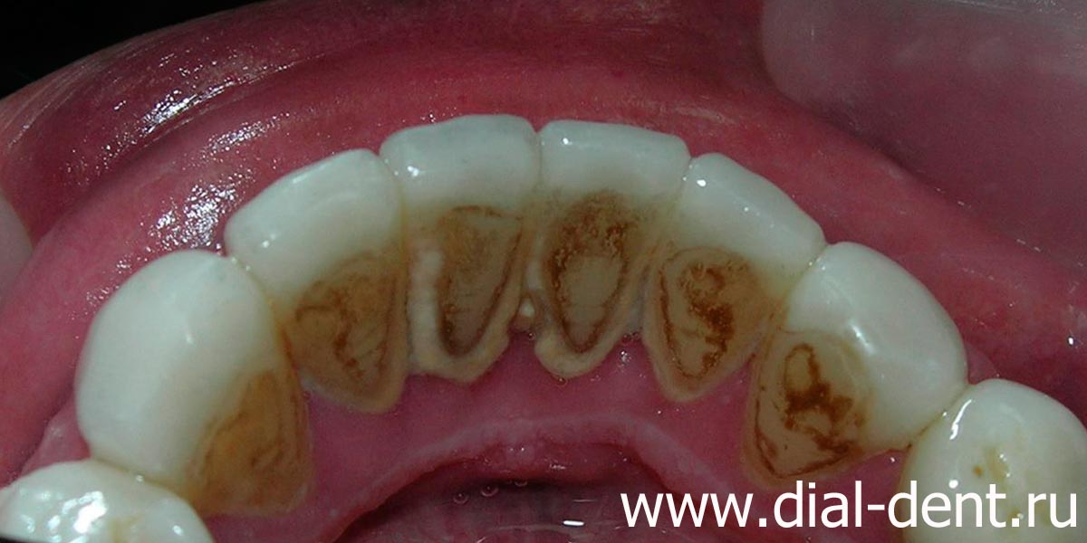 скопление зубного налета на внутренней поверхности зубов, покрытых винирами