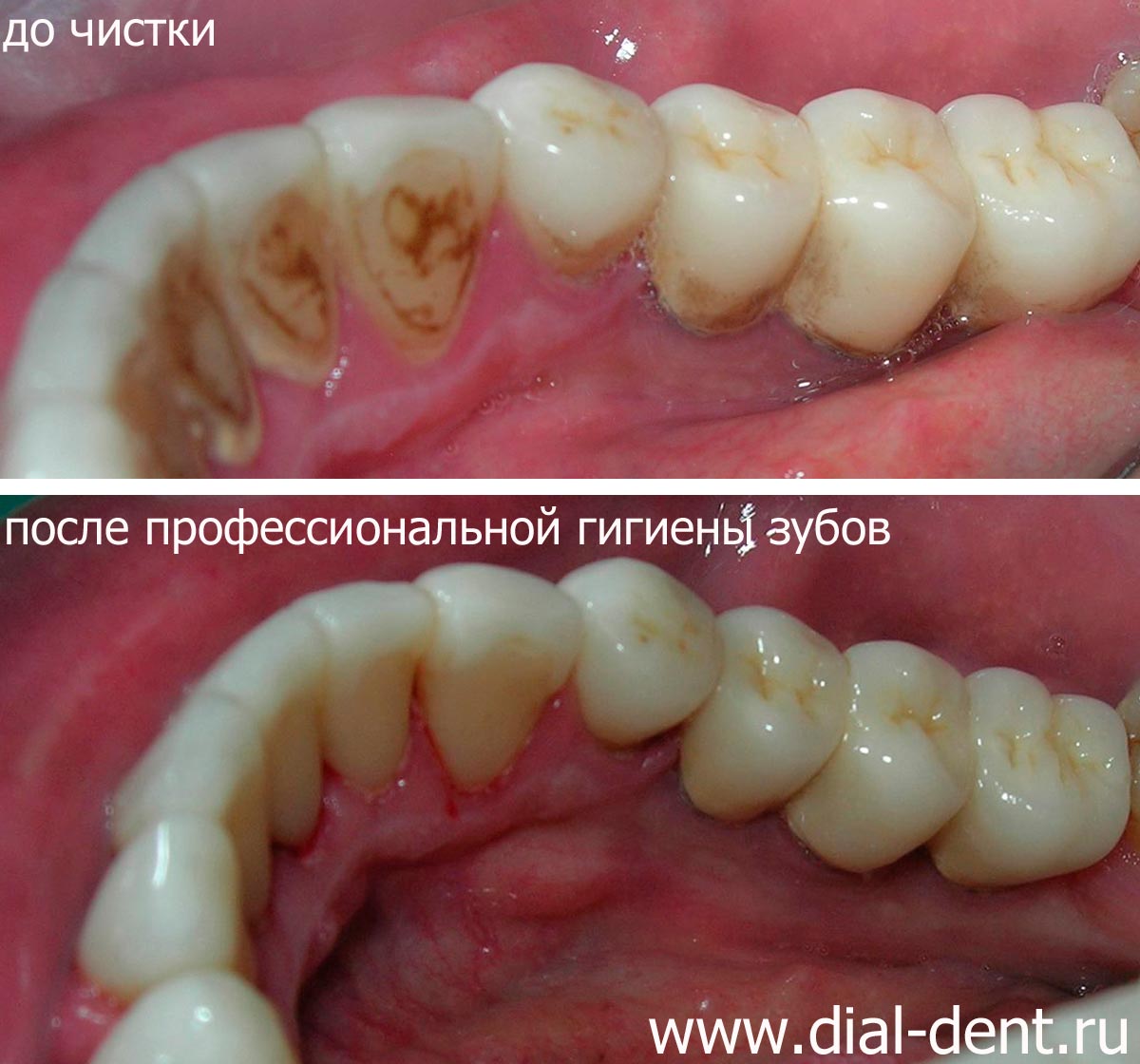 зубной налет и результат профессиональной гигиены зубов
