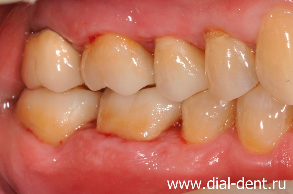 результат лечения и протезирования зубов - вид сбоку