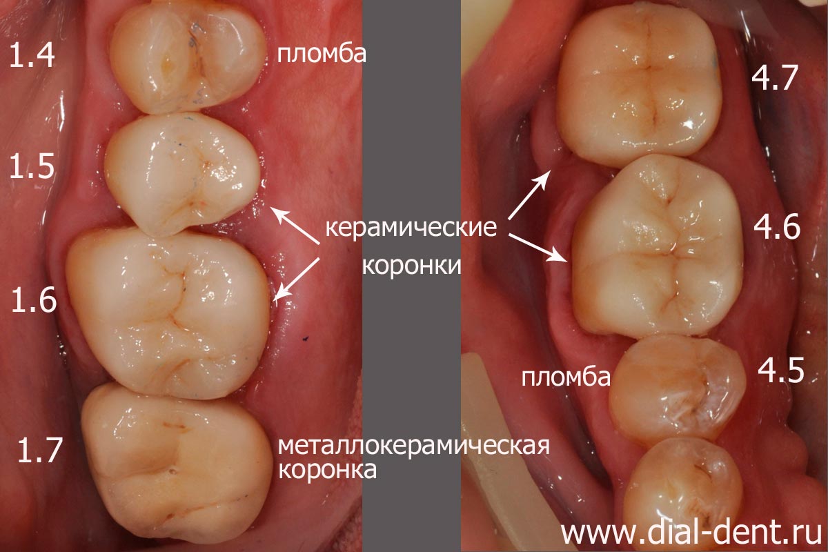 результат комплексного лечения и протезирования зубов в Диал-Дент