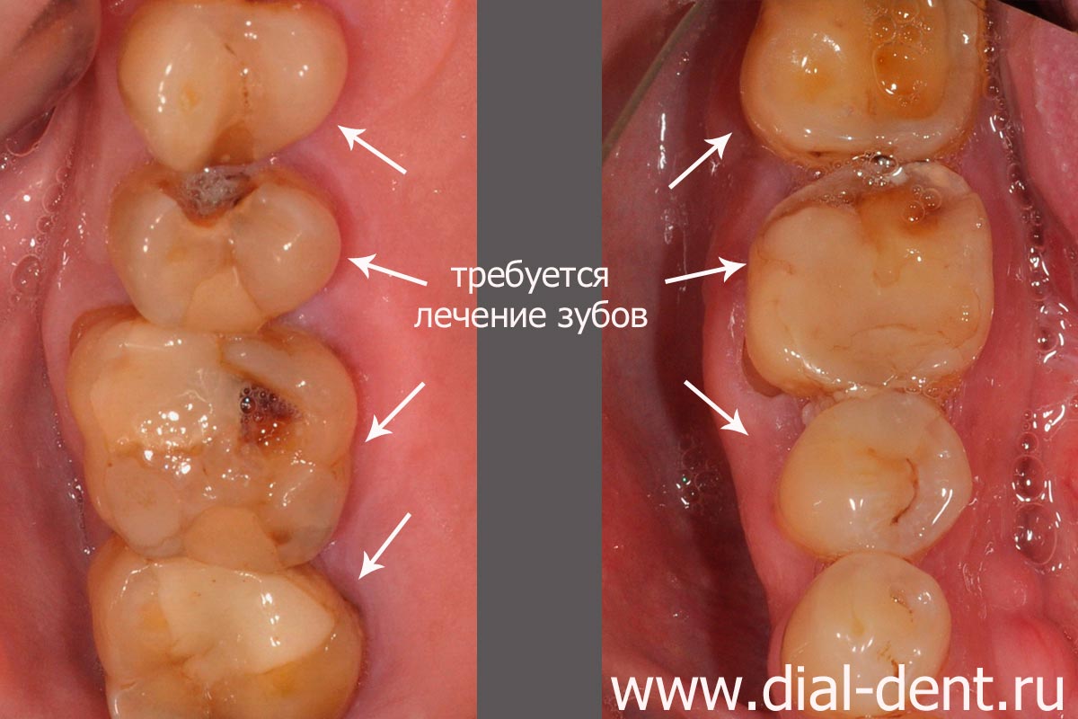 состояние зубов до лечения