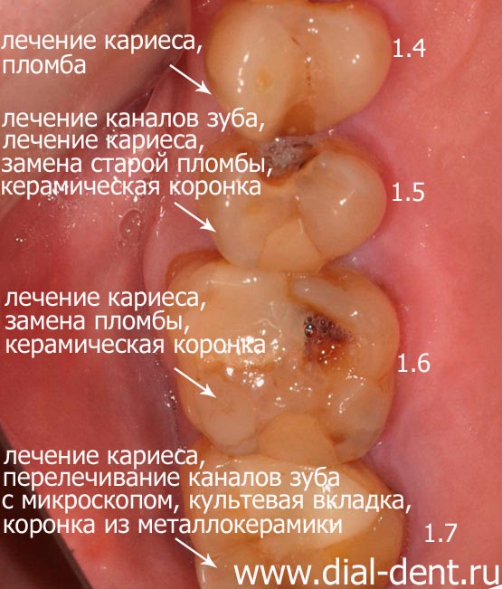 план лечения верхних зубов