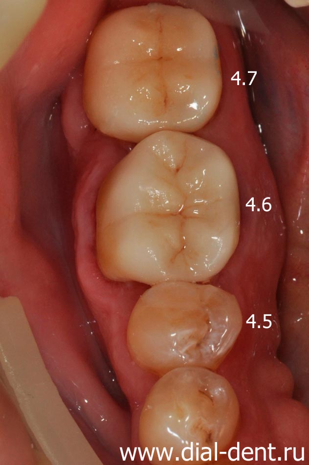 результат лечения и протезирования зубов