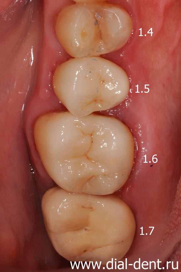 результат лечения и протезирования зубов
