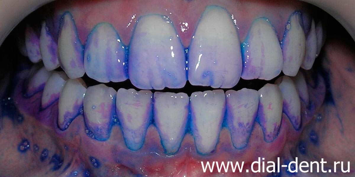 индикация зубного налета: свежий налет - красный, старый налет - синий