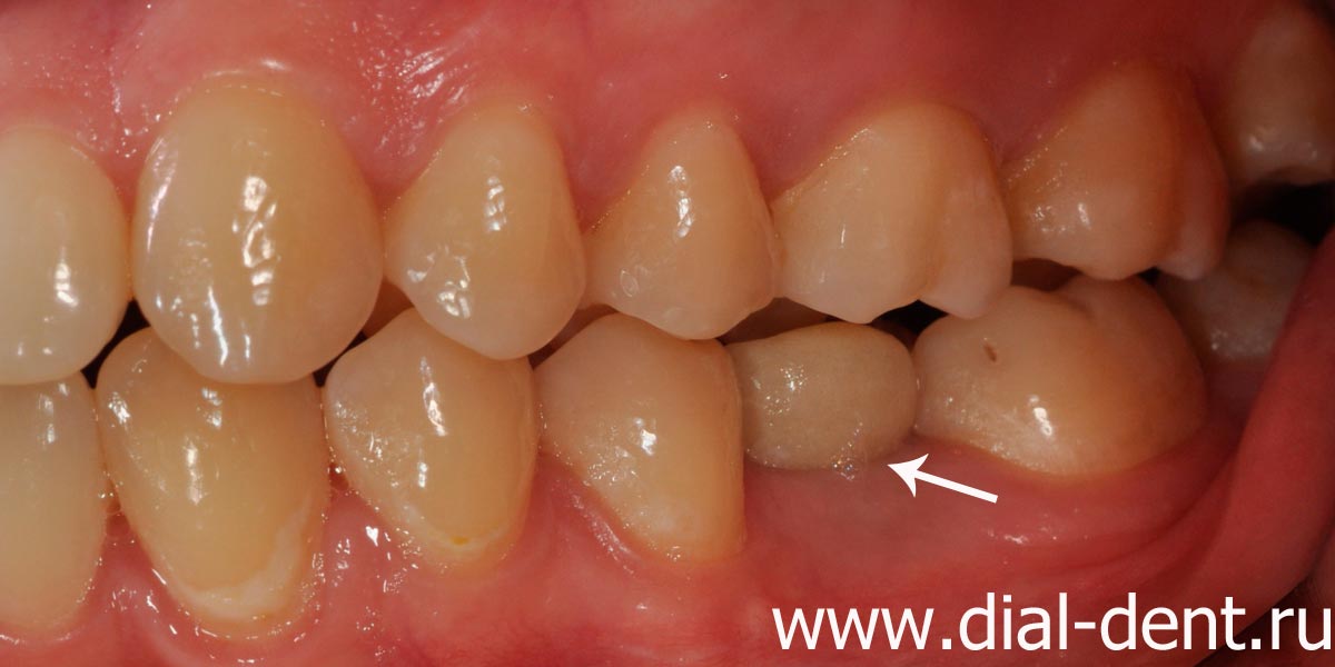 временая коронка, установленная на зубной имплант, не устраивает пациентку