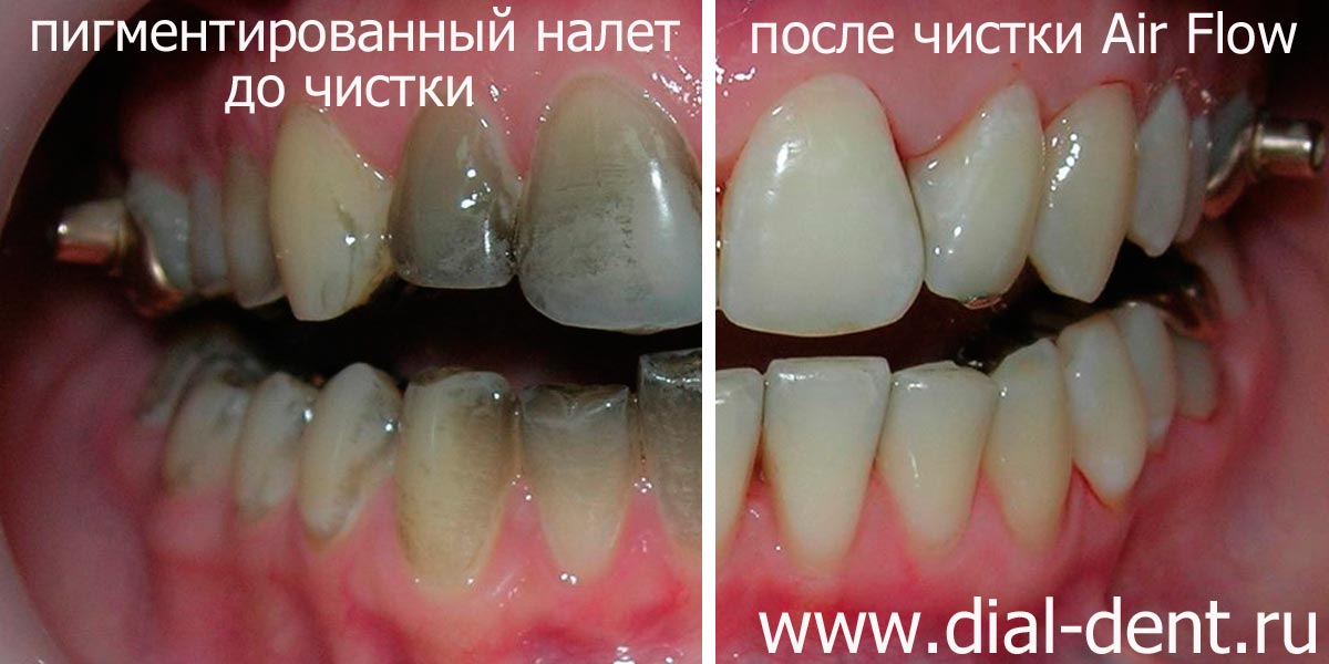 результат чистки зубов в Диал-Дент