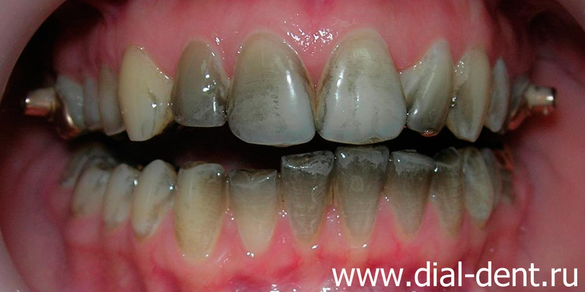 черный налет на зубах, скопление зубного налета у десен и между зубами