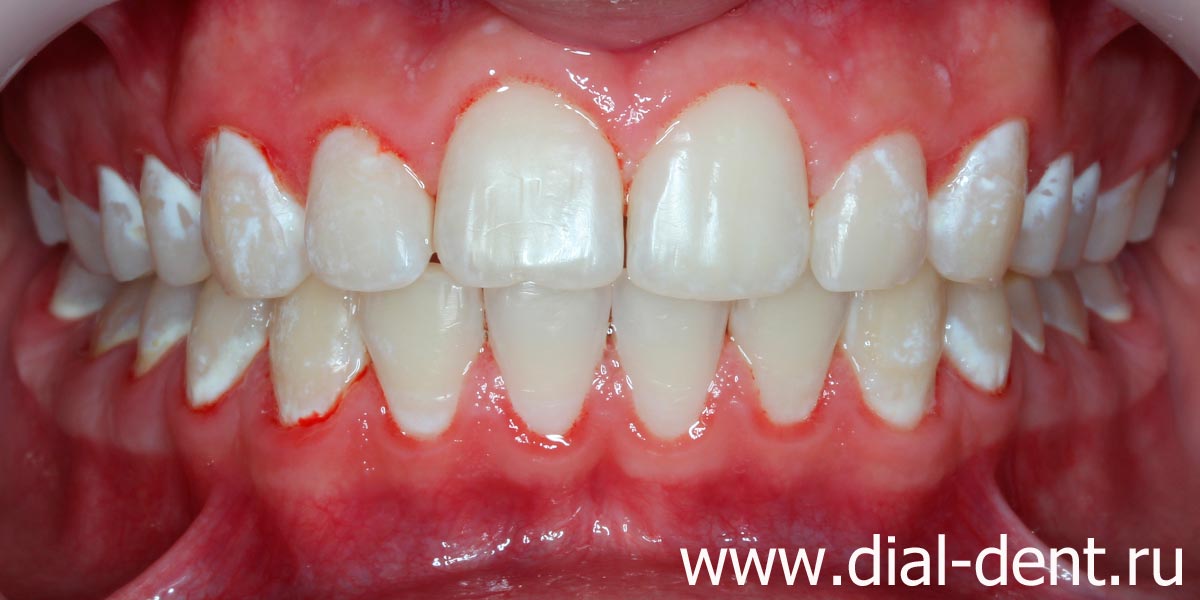 выполнена профессиональная чистка зубов, для лечения кариеса пациент записан к стоматологу