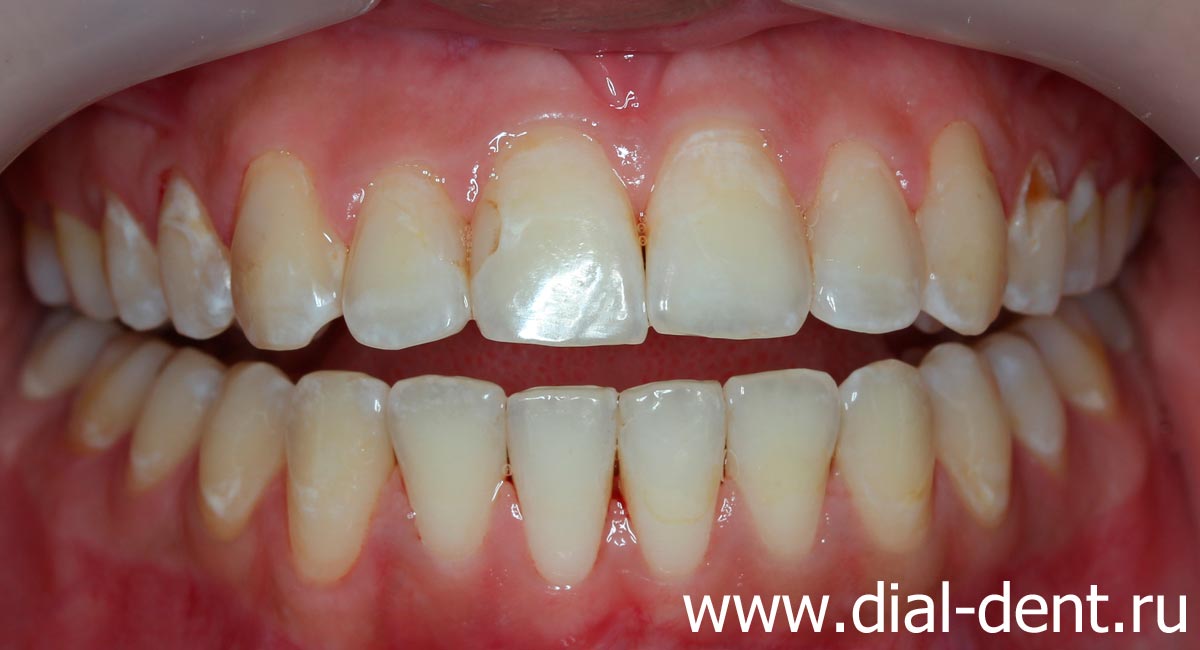 чистые и отполированные зубы после профессиональной гигиены полости рта