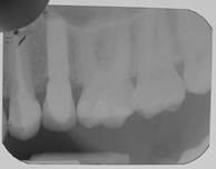после имплантации зубов - контрольный рентген