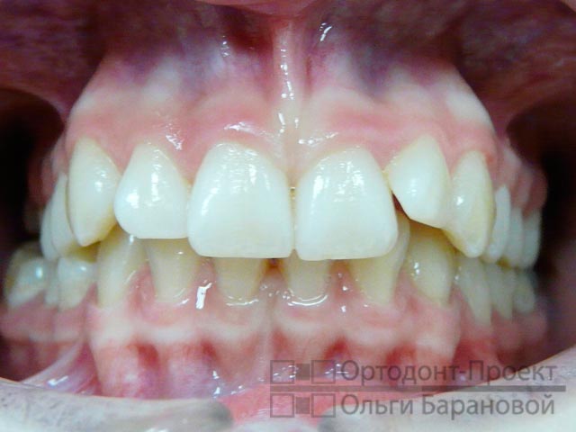 вид зубов до лечения у ортодонта