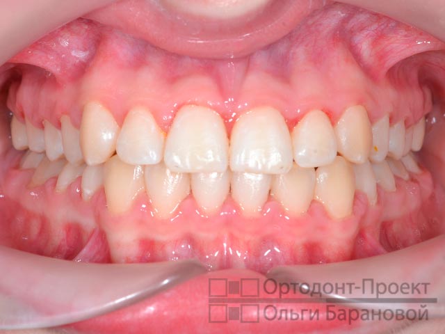 вид зубов после лечения у ортодонта