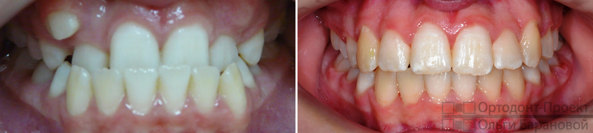 вид зубов до и после лечения у ортодонта О.А. Барановой