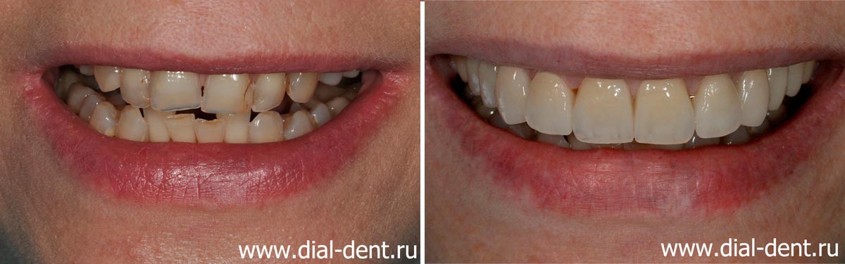 реставрация передних зубов в Диал-Дент Москва