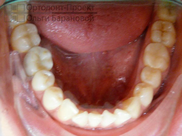фото нижних зубов при обращении к ортодонту