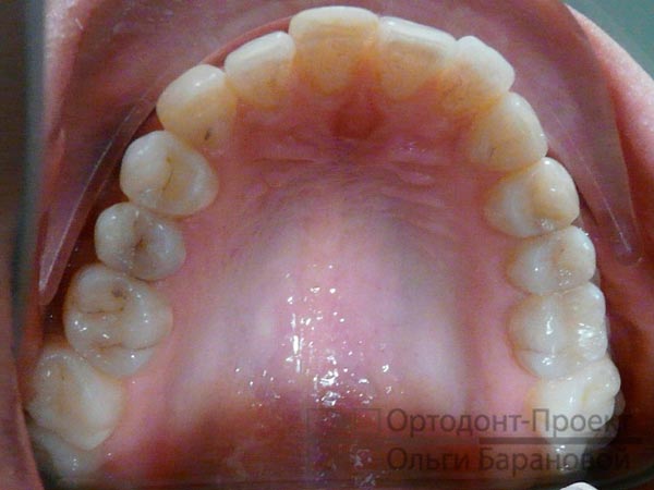 фото верхних зубов при обращении к ортодонту