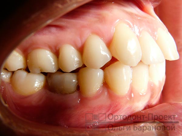 фото зубов при обращении к ортодонту