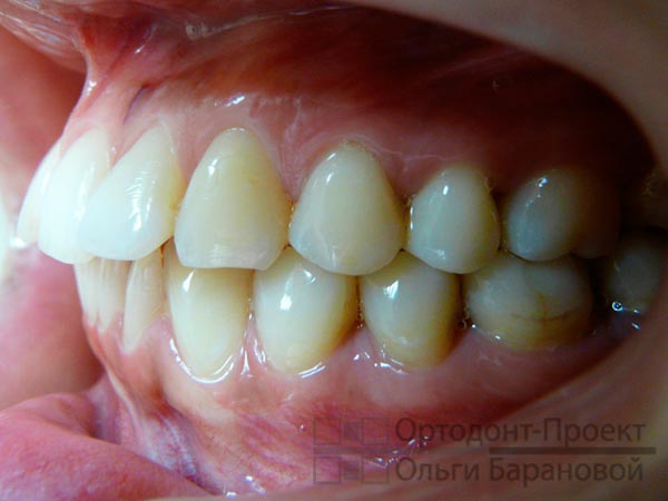 фото зубов при обращении к ортодонту