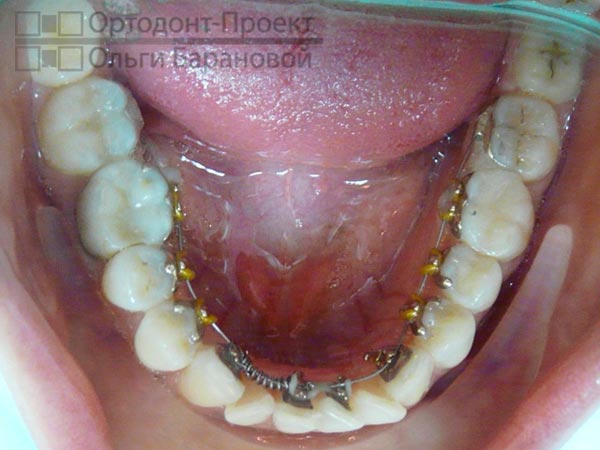 брекеты Инкогнито на нижних зубах