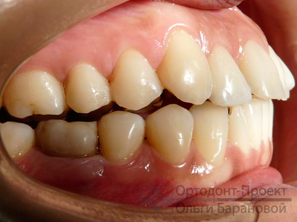 вид зубов с брекетами Инкогнито
