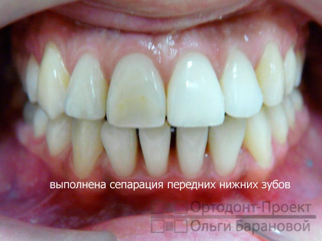 проведена сепарация зубов