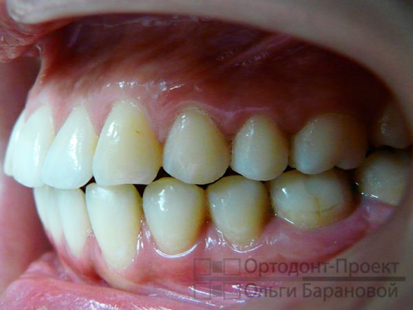 проведена сепарация зубов