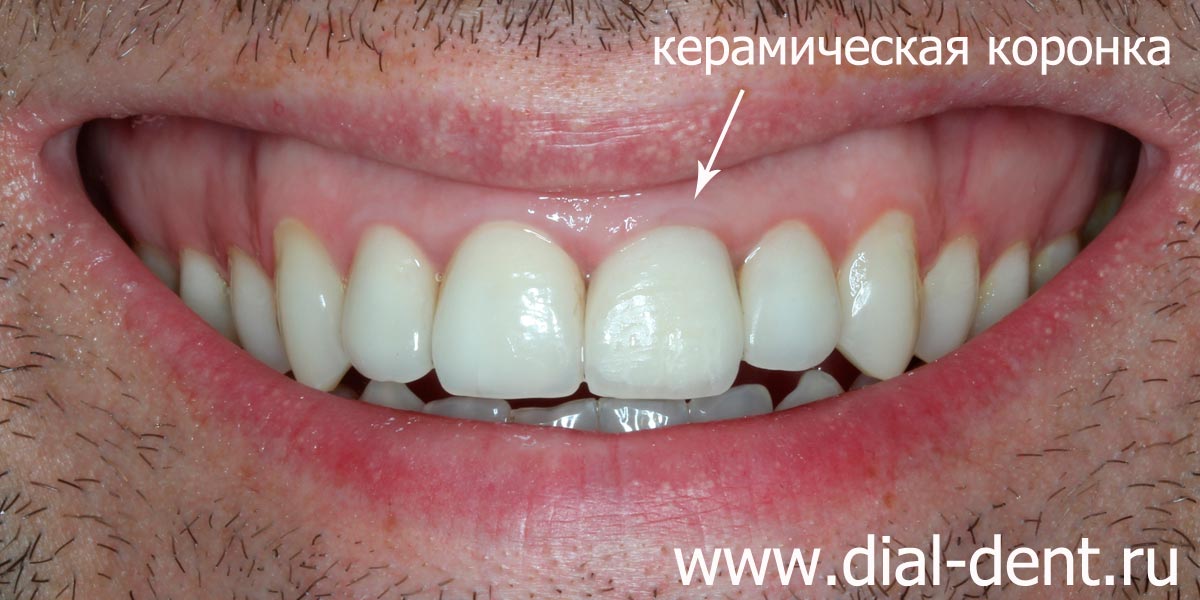 реставрация переднего зуба керамической коронкой