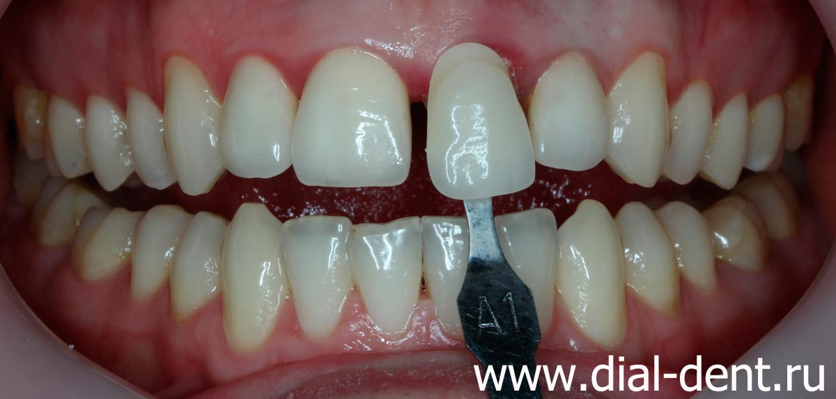 определение цвета реставрации переднего зуба