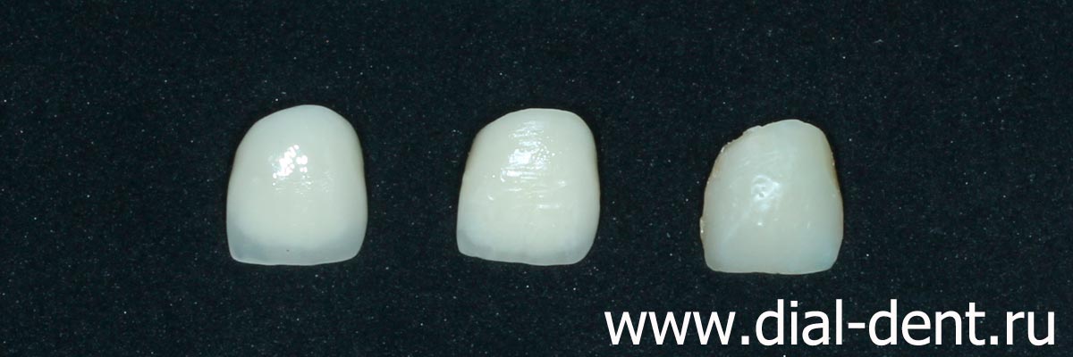 коронка из керамики на передний зуб изготовлена в нескольких вариантах