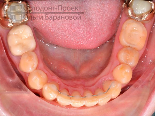 результат ортодонтического лечения