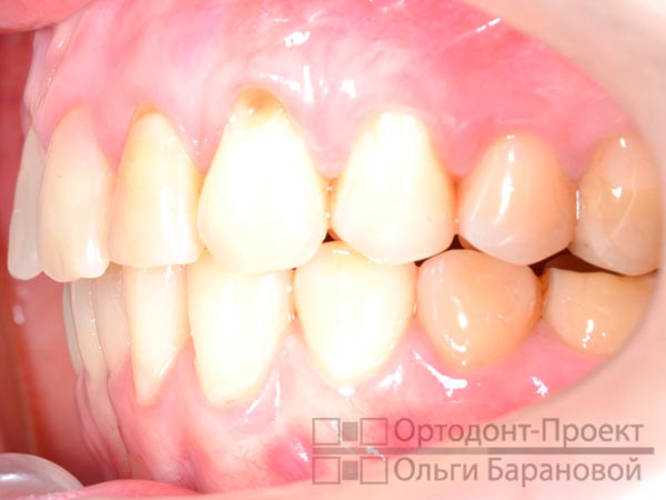 результат ортодонтического лечения