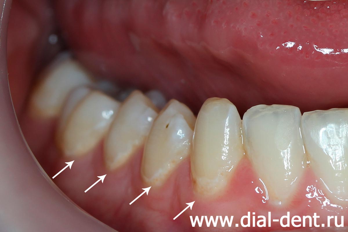 нарушение минерального состава эмали в местах длительного скопления зубного налета