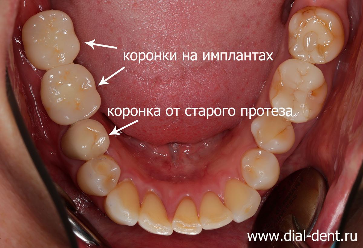 протезирование зубов на имплантах завершено